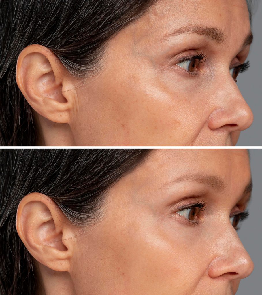 Skin Rejuvenation