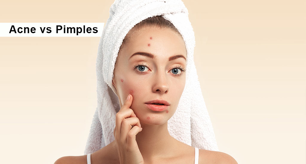 acne vs pimples